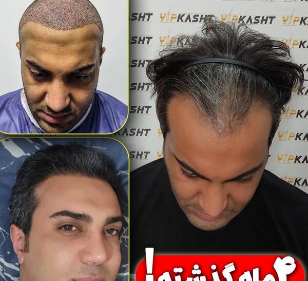 عکس قبل و بعد کاشت مو علی قلی زاده