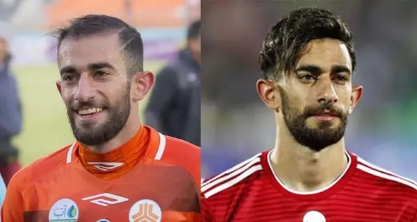 عکس قبل و بعد کاشت مو علی قلی زاده