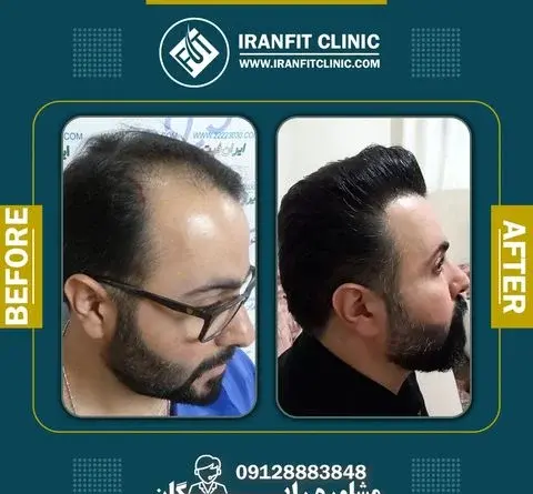 عکس های قبل و بعد از کاشت مو