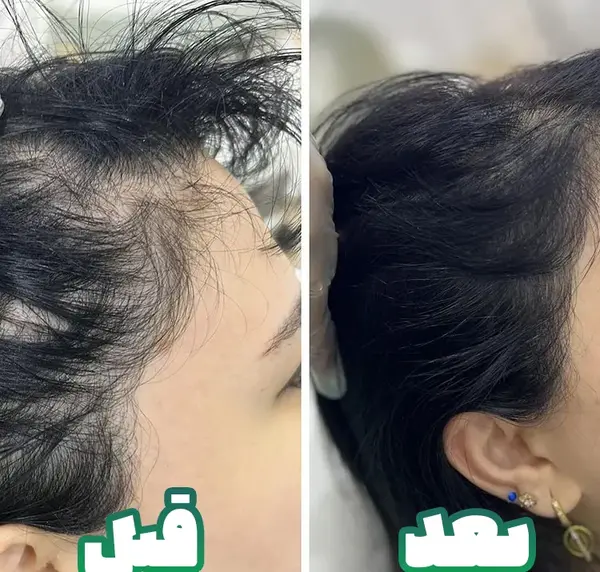 عکس های قبل و بعد از کاشت مو