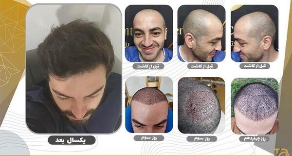 عکس های قبل و بعد از کاشت مو
