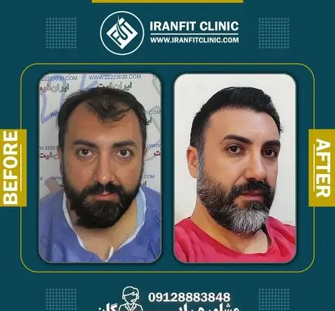 عکس های قبل و بعد از کاشت مو
