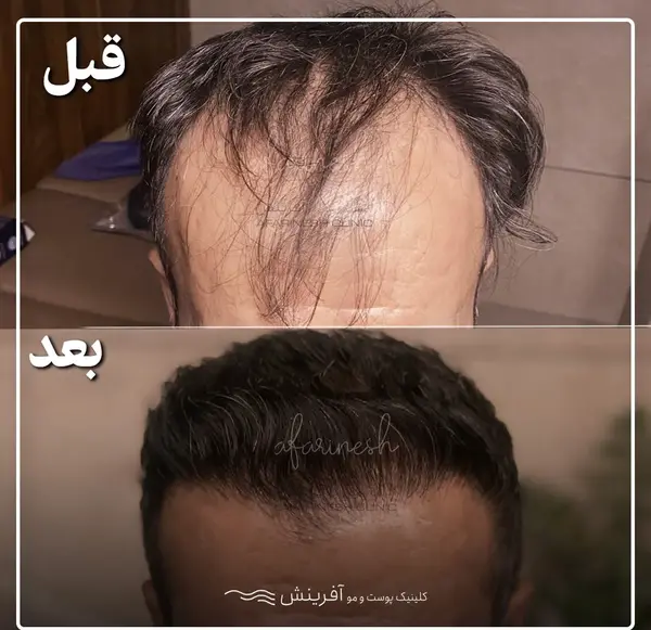 عکس های قبل و بعد از کاشت مو