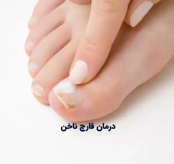 عکس قارچ ناخن بعد از کاشت