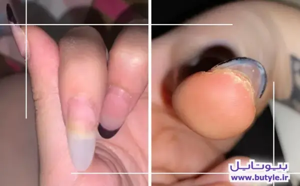 عکس قارچ ناخن بعد از کاشت