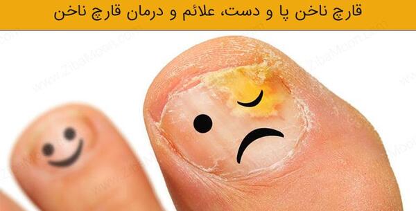 عکس قارچ ناخن بعد از کاشت