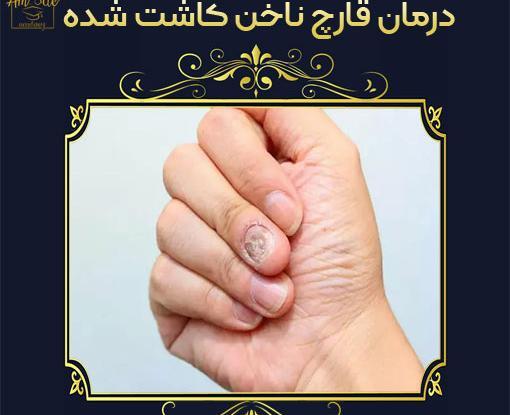 عکس قارچ ناخن بعد از کاشت