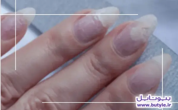 عکس قارچ ناخن بعد از کاشت