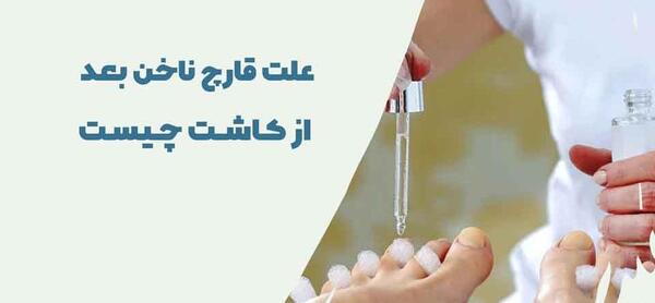 عکس قارچ زیر ناخن کاشت