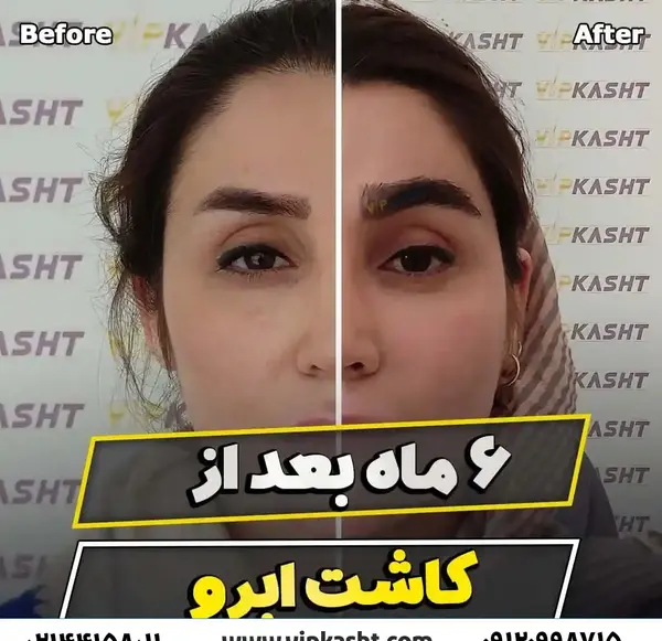 عکس های قبل و بعد کاشت ابرو
