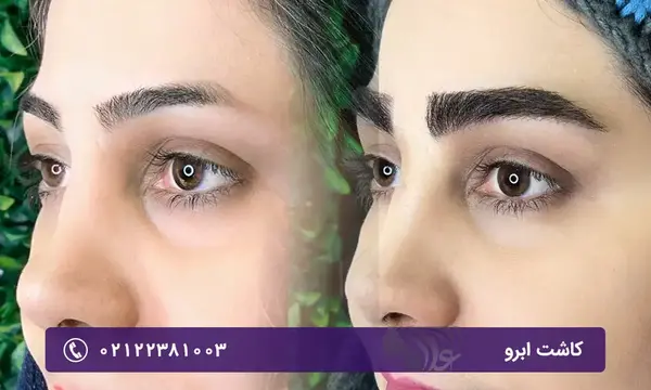 عکس های قبل و بعد کاشت ابرو