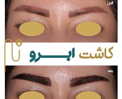 عکس های قبل و بعد کاشت ابرو