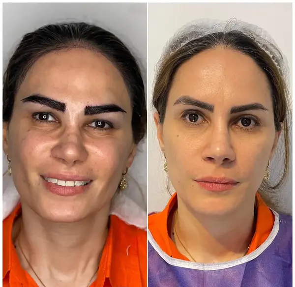 عکس های قبل و بعد کاشت ابرو