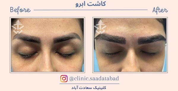 عکس های قبل و بعد کاشت ابرو