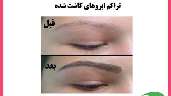 عکس های قبل و بعد کاشت ابرو
