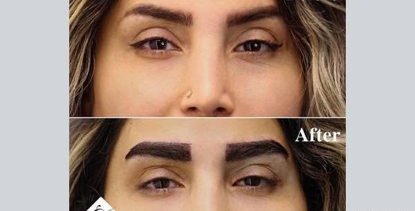 عکس های قبل و بعد کاشت ابرو