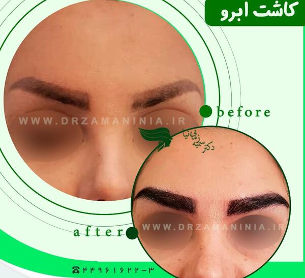 عکس های قبل و بعد کاشت ابرو