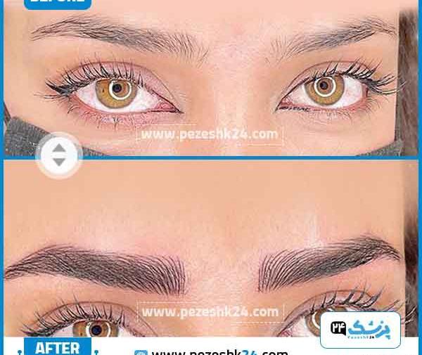 عکس های قبل و بعد کاشت ابرو