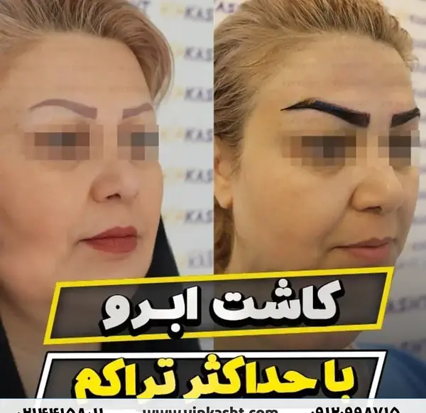 عکس های قبل و بعد کاشت ابرو