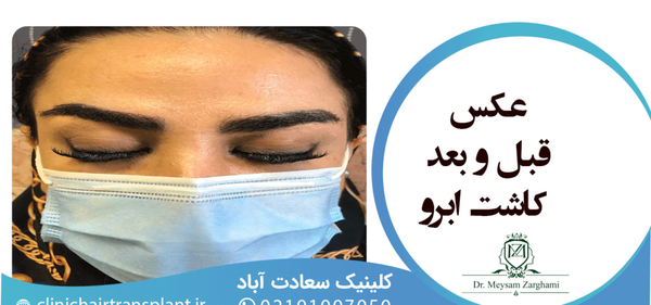 عکس های قبل و بعد کاشت ابرو