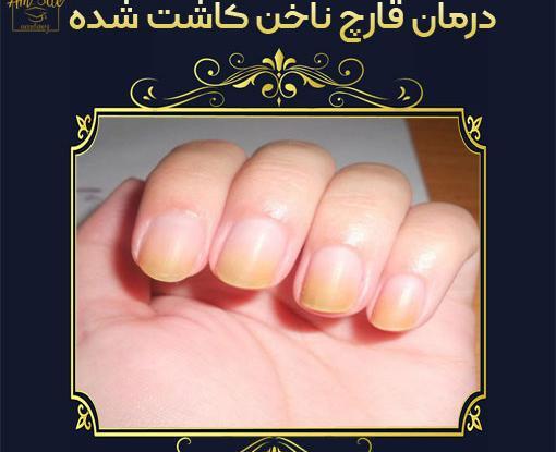 عکس کاشت ناخن قارچ زده