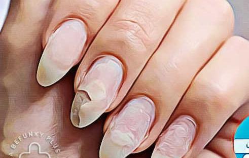عکس کاشت ناخن قارچ زده
