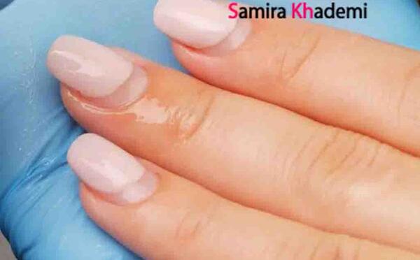 عکس کاشت ناخن قارچ زده
