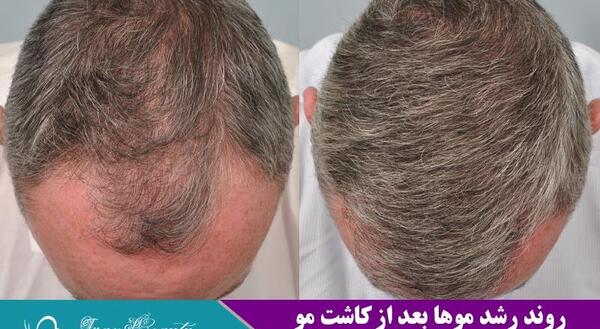 عکس موی کاشته شده