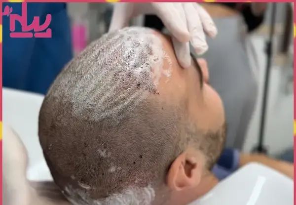 عکس موی کاشته شده