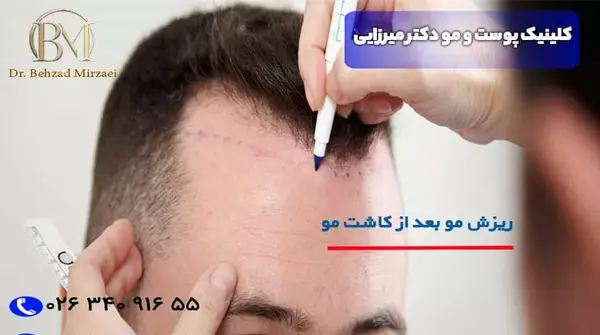 عکس موی کاشته شده