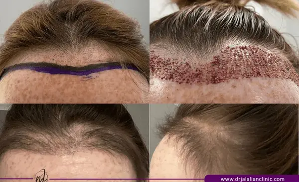 عکس موی کاشته شده