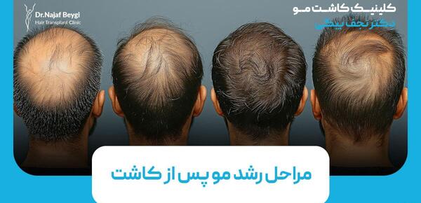 عکس موی کاشته شده