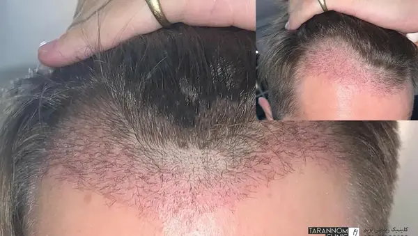 عکس موی کاشته شده