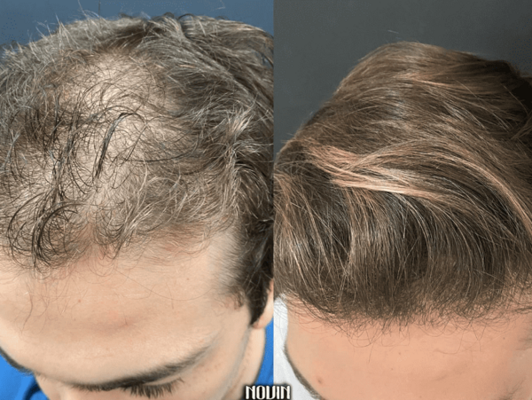 عکس موی کاشته شده