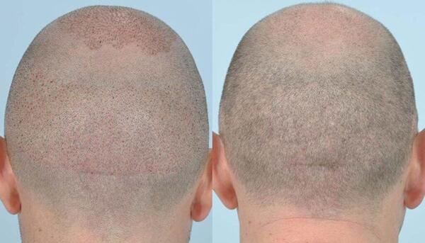 عکس موی کاشته شده