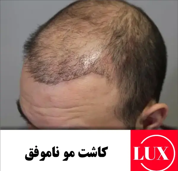 عکس موی کاشته شده