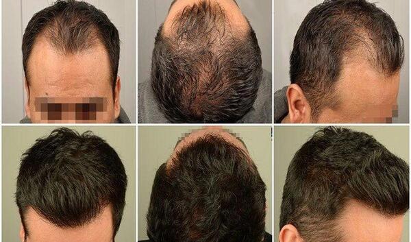 عکس مهران غفوریان بعد از کاشت مو