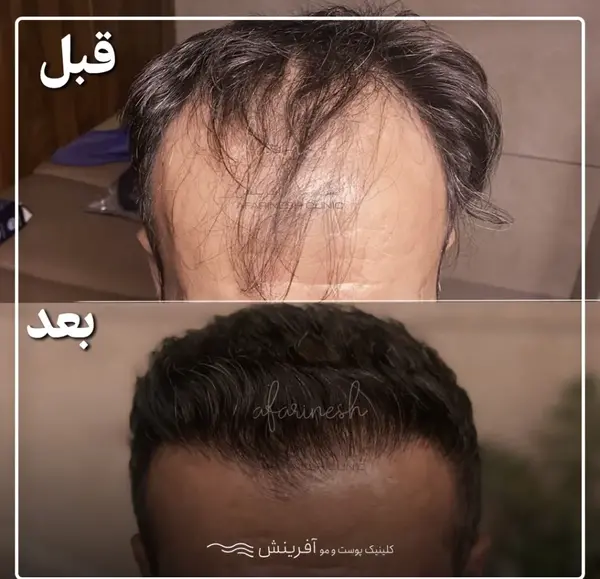 عکس مهران غفوریان بعد از کاشت مو