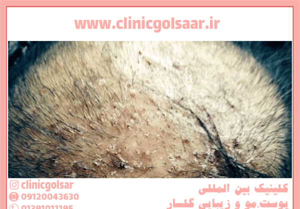 عکس عفونت بعد از کاشت مو