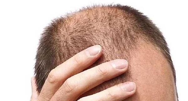 عکس عفونت بعد از کاشت مو