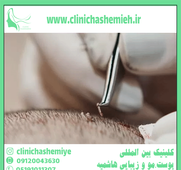 عکس عفونت بعد از کاشت مو