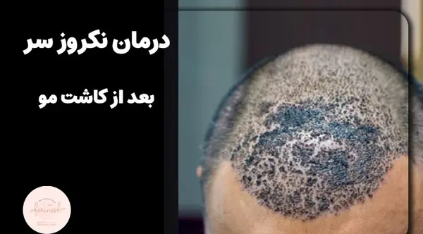 عکس عفونت بعد از کاشت مو