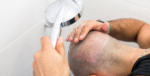 عکس عفونت سر بعد از کاشت مو