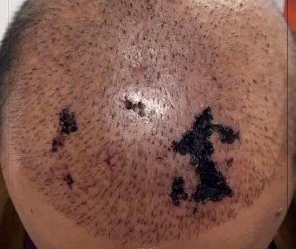 عکس عفونت سر بعد از کاشت مو