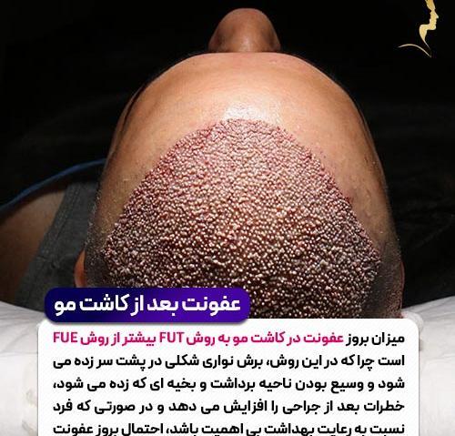 عکس عفونت سر بعد از کاشت مو