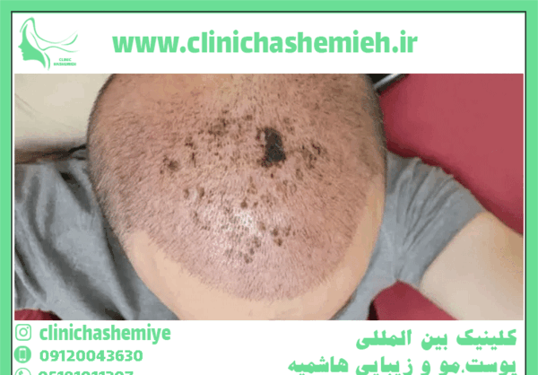 عکس عفونت سر بعد از کاشت مو