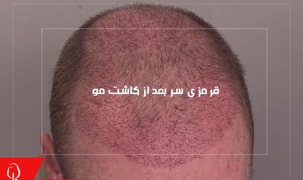 عکس عفونت سر بعد از کاشت مو