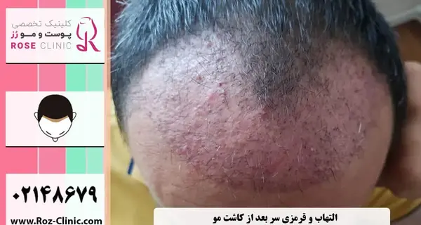عکس عفونت سر بعد از کاشت مو