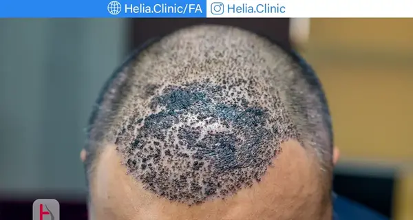 عکس عفونت سر بعد از کاشت مو