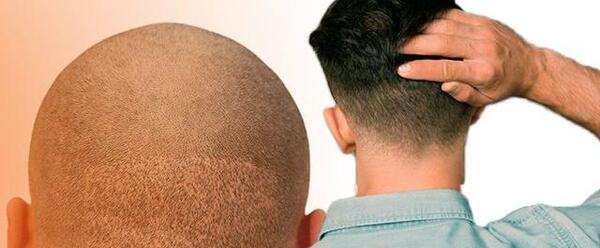 عکس عفونت سر بعد از کاشت مو